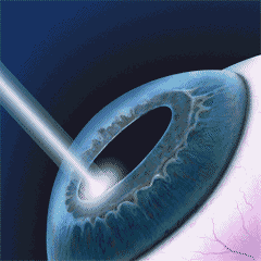 centre-ophtalmologie-la-ciotat-docteur-jerome-madar-chirurgie-refractive-au-laser-excimer-01