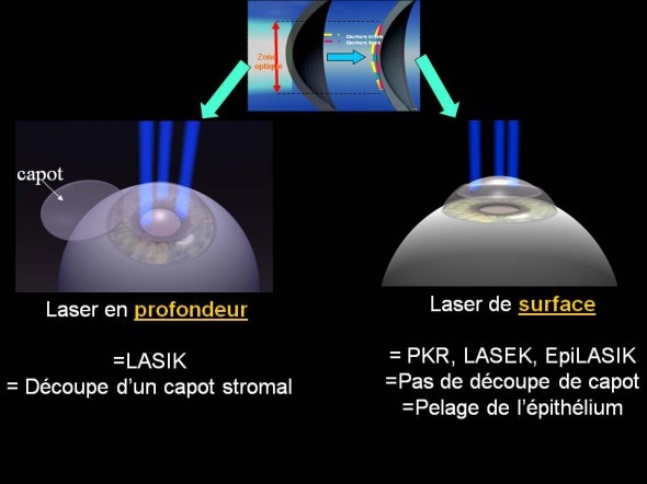 centre-ophtalmologie-la-ciotat-docteur-jerome-madar-chirurgie-refractive-au-laser-excimer-04