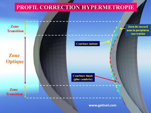 centre-ophtalmologie-la-ciotat-docteur-jerome-madar-chirurgie-refractive-au-laser-excimer-06